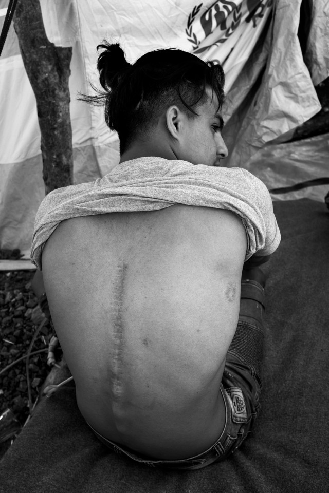 A minor Syrian paralyzed showing his bullet wound at the Olive Grove informal extension to the refugee camp Moria, Lesbos, Greece A minor Syrian paralyzed showing his bullet wound at the Olive Grove informal extension to the refugee camp Moria, Lesbos, Greece